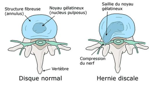 hernie-discale-1.jpg