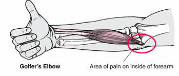 golfers-elbow.gif