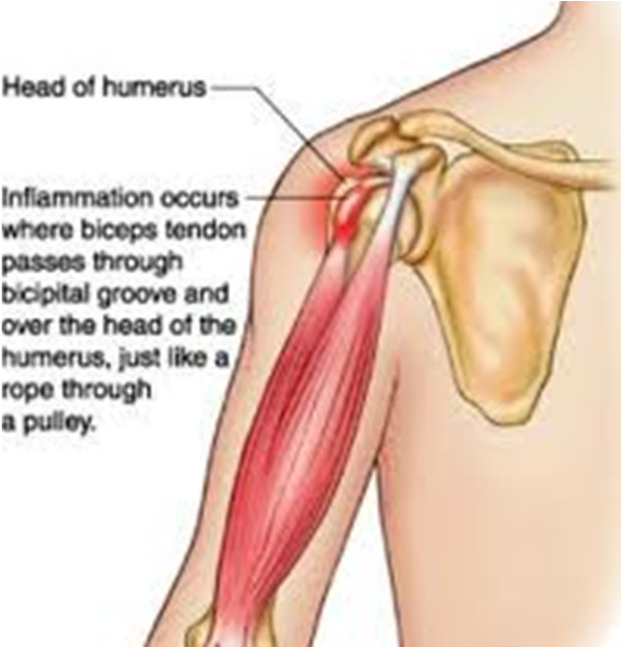 BicepsTendinitis-pic1.png